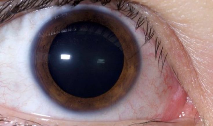 an extreme close up shot of someone's eye with dark circles on the iris