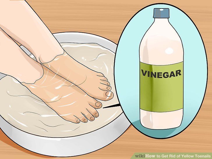 fungal nail pedicure Brittle Toenails, Clean Toenails, Yellow Toenails, Yellow Toe Nails, Remove Yellow Stains, Toenail Fungal Infection, Nail Discoloration, Nail Remedies, Toenail Fungus Remedies