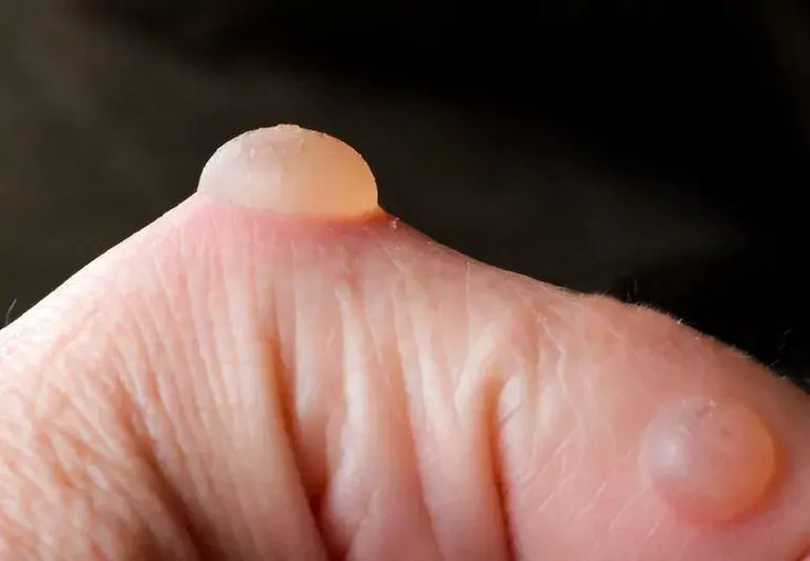 Wherever they came from, the temptation to pop a blister may just get the best of you. But experts say that’s usually not your best bet. Our dermatologist explains why you shouldn’t pop most blisters and how, instead, to treat three common kinds of blisters. Burn Blister, How To Treat Blisters, Sinus Massage, Body Forms, Respiratory Illness, Body Form, Itchy Scalp, Massage Techniques, Blow Dry