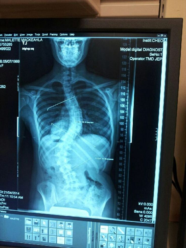 an x - ray image on a computer screen shows the chest and upper body areas