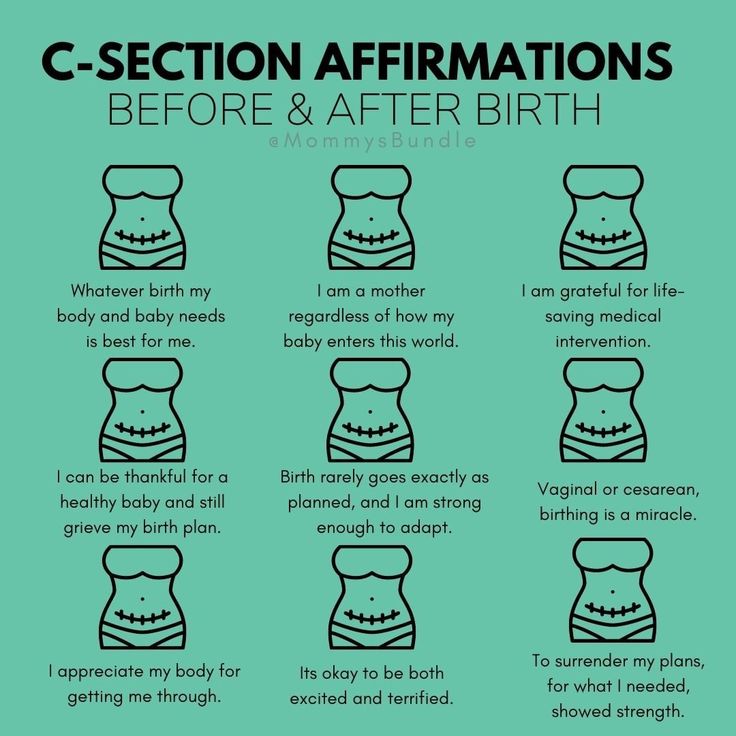 Positive C Section Affirmations, Csection Birth Affirmations, Birth Affirmations C Section, C Section Quotes Inspiration, C Section Affirmations, C Section Mom Quotes, C Section Quotes, Postpartum Education, C Section Birth Plan