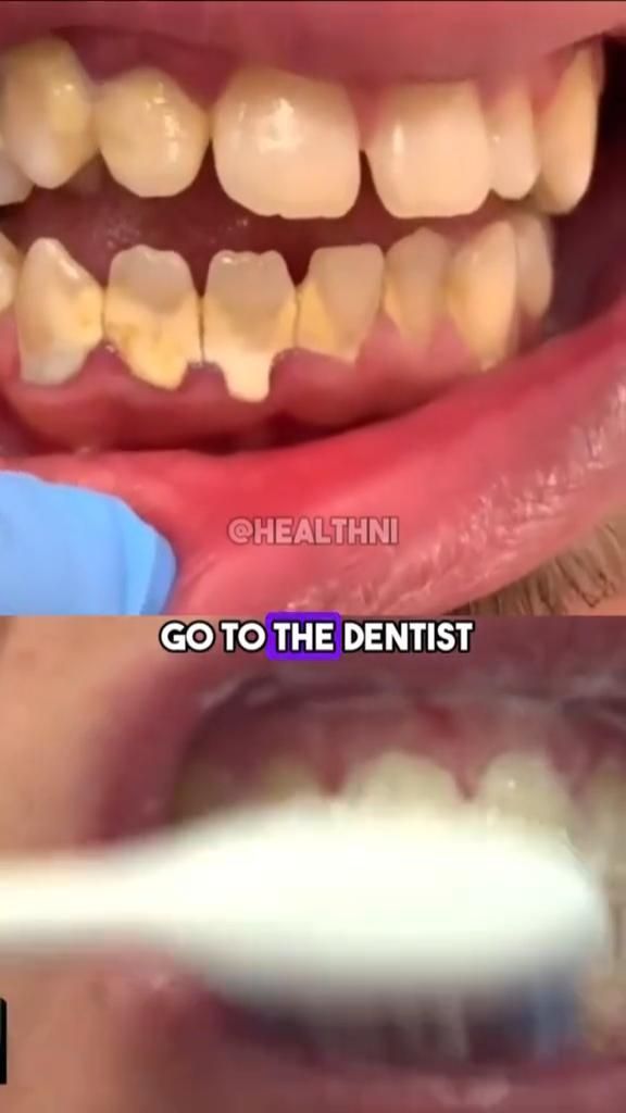 NATURAL RECIPE TO WHITTEN YOUR TEETH Tatoo 3d, Beginner Skin Care Routine, Teeth Whitening Homemade, Teeth Whitening Remedies, Teeth Whitening Diy, Skin Care Basics, Diy Skin Care Routine, Good Skin Tips, Teeth Health