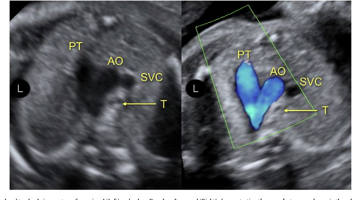 Heart Ultrasound, Ob Ultrasound, Gyn Ultrasound, Aortic Arch, Fetal Ultrasound, Coarctation Of The Aorta, Ultrasound School, Obstetric Ultrasound, Cardiac Sonography