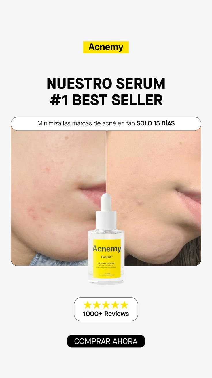 Minimiza las marcas de acné en tan SOLO 15 DÍAS Serum, Acne