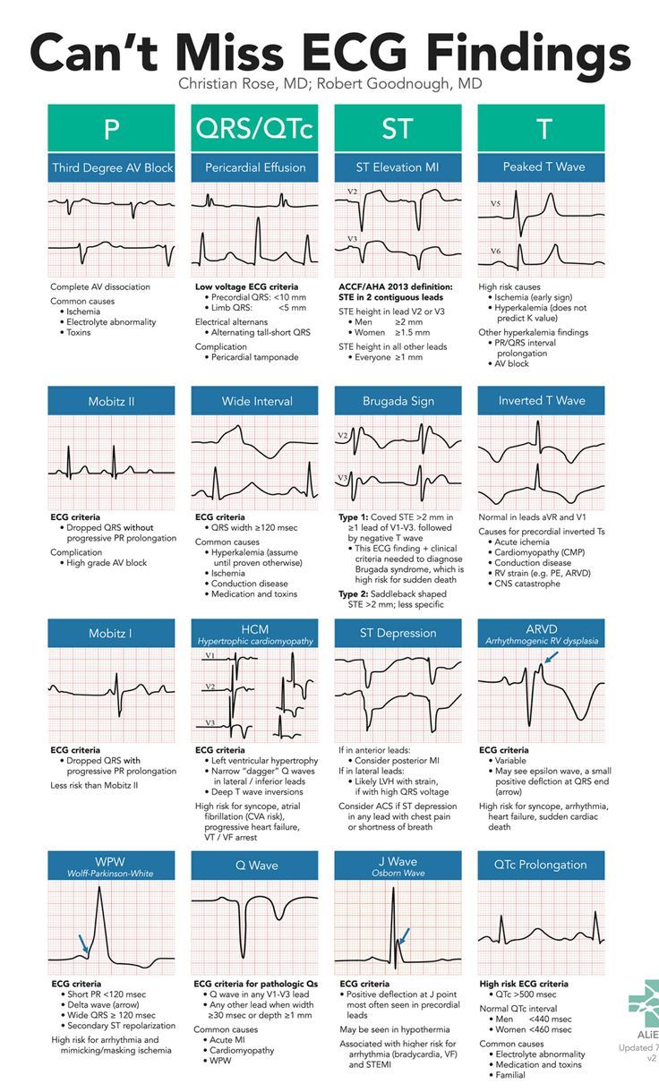 A high yield, on-shift resource to help Emergency Department providers spot subtle, high-risk ECG findings including Brugada, WPW, HCM, and ARVD. Use this card as a checklist to methodically ensure you are not missing any electrocardiographic evidence of red-flag conditions. Medische Humor, Cardiology Nursing, Paramedic School, Nursing Mnemonics, Cardiac Nursing, Nursing School Survival, Critical Care Nursing, Nursing School Studying, Nursing School Tips