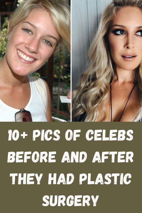 Cheek Implants, Plastic Surgery Fail, Face Surgery, Botox Lips, Plastic Surgery Gone Wrong, Layered Haircuts For Medium Hair, Celebrity Plastic Surgery, Celebrities Before And After, Short Women Fashion