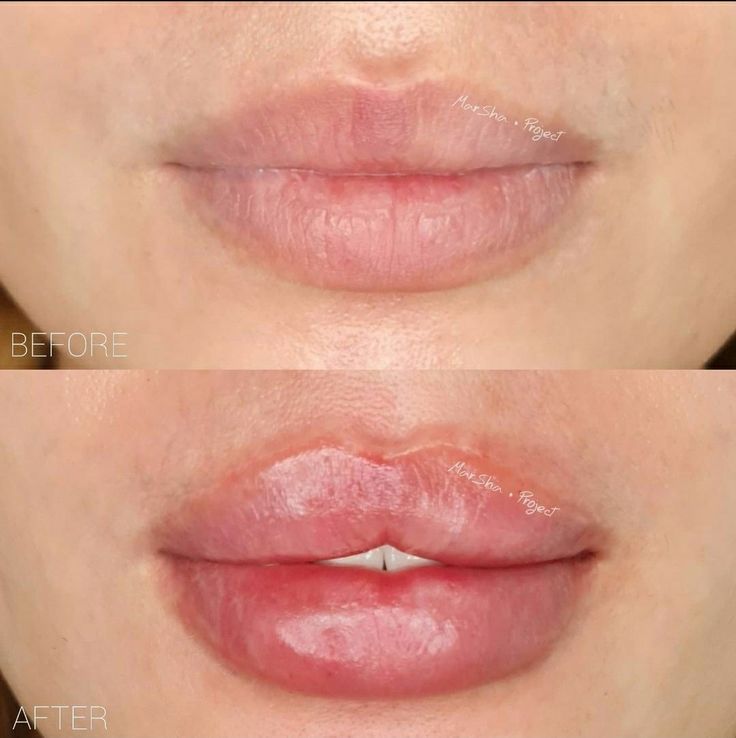 Key Hole Lips Injections, Pillow Lips Injections, Keyhole Lip Injections, Russian Keyhole Lips, Lip Filler Shape Ideas Pouty, Bratz Doll Lip Filler, Lip Gel Injection, Keyhole Pout Lips, Change Lip Shape