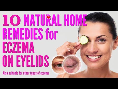 Eye Irritation Remedies, Itchy Eyes Remedy, Home Remedies For Rashes, Home Remedies For Face, Rash On Face, Rashes Remedies, Allergy Eyes, Home Remedies For Allergies, Home Remedies For Warts