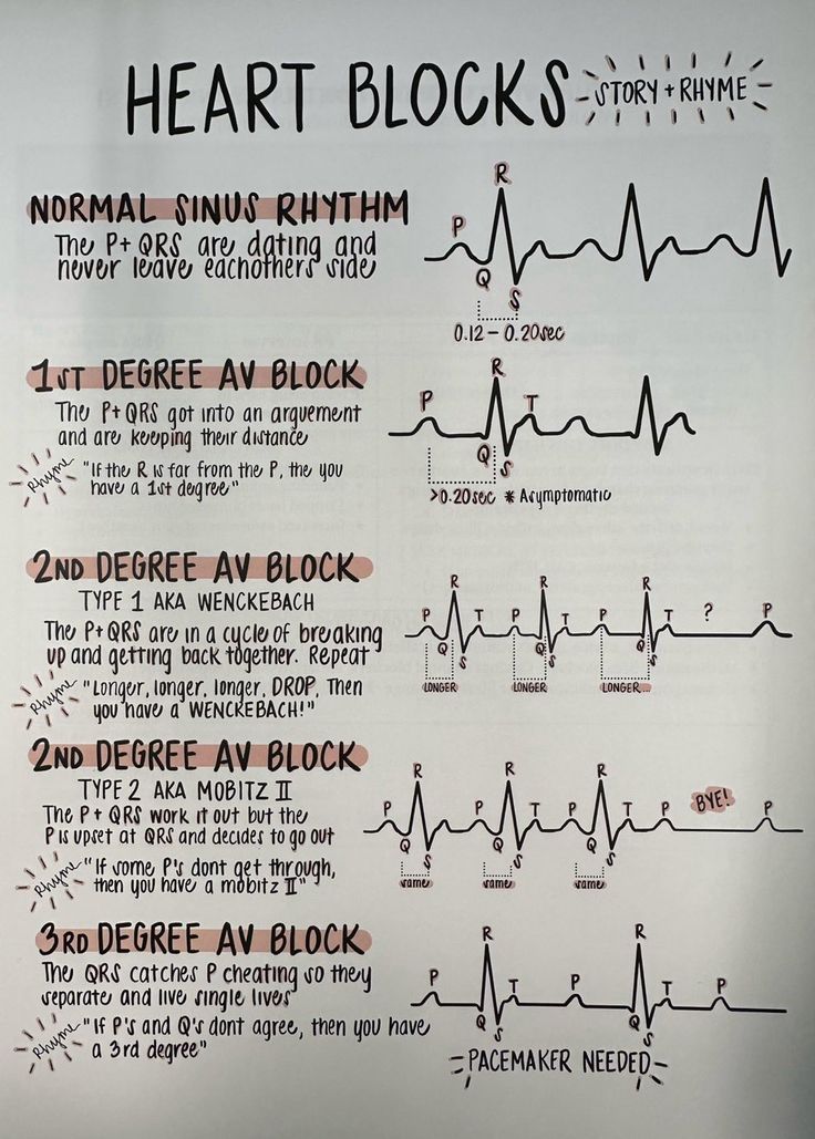 Cardiac Dysrhythmias Nursing, Cardiology Medical Assistant, Cardiac Tamponade Nursing, Heart Rythym Chart, Cardiac Monitor Tech, How To Read Ekg, Med Surg Cardiac, Ekg Study Notes, Ekg Electrode Placement