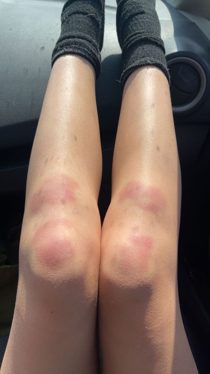 the legs and arms of a woman sitting in a car with sunburns on