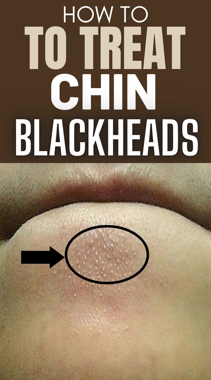 How to Quickly and Easily Remove Blackheads from Your Chin at Home #Remedies #HomeRemedies #NaturalRemedies #Blackheads #Skincare #SkincareTips #blackheadproblems #skinhealth. Find out more here 👉 https://whispers-in-the-wind.com/effective-ways-to-get-rid-of-blackheads-expert-tips/?blackheads Blackheads On Face, Blind Pimple, Blackheads On Nose, Face Pores, Remove Blackheads, How To Get Rid Of Pimples, Get Rid Of Blackheads, Unwanted Hair Removal, Skin Care Solutions