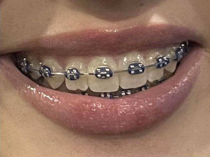 Braces Vision Board, Brackets Aesthetic, Perfect Teeth Braces, Grey Braces, Braces And Glasses, Teeth With Braces, Silver Braces, Braces Smile, Black Braces