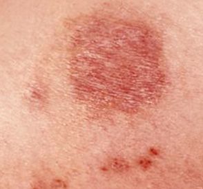 Identify Bug Bites - Common Bug Bites | Orkin Bug Bites Identifying Chart, Brown Recluse Spider Bite Stages, Spider Bite Symptoms, Spider Bites Pictures, Recluse Spider Bite, Brown Recluse Spider Bite, Spider Bite, Recluse Spider, Brown Recluse Spider