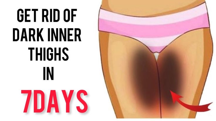 CLEAR DARK THIGHS USING THIS SIMPLE NATURAL REMEDY || DARK THIGHS REMEDY Dark Inner Thighs, Hacks Clothes, Natural Remedy, Fashion Hacks, Inner Thigh, Fashion Hacks Clothes, Natural Remedies, Fashion Tips, Quick Saves