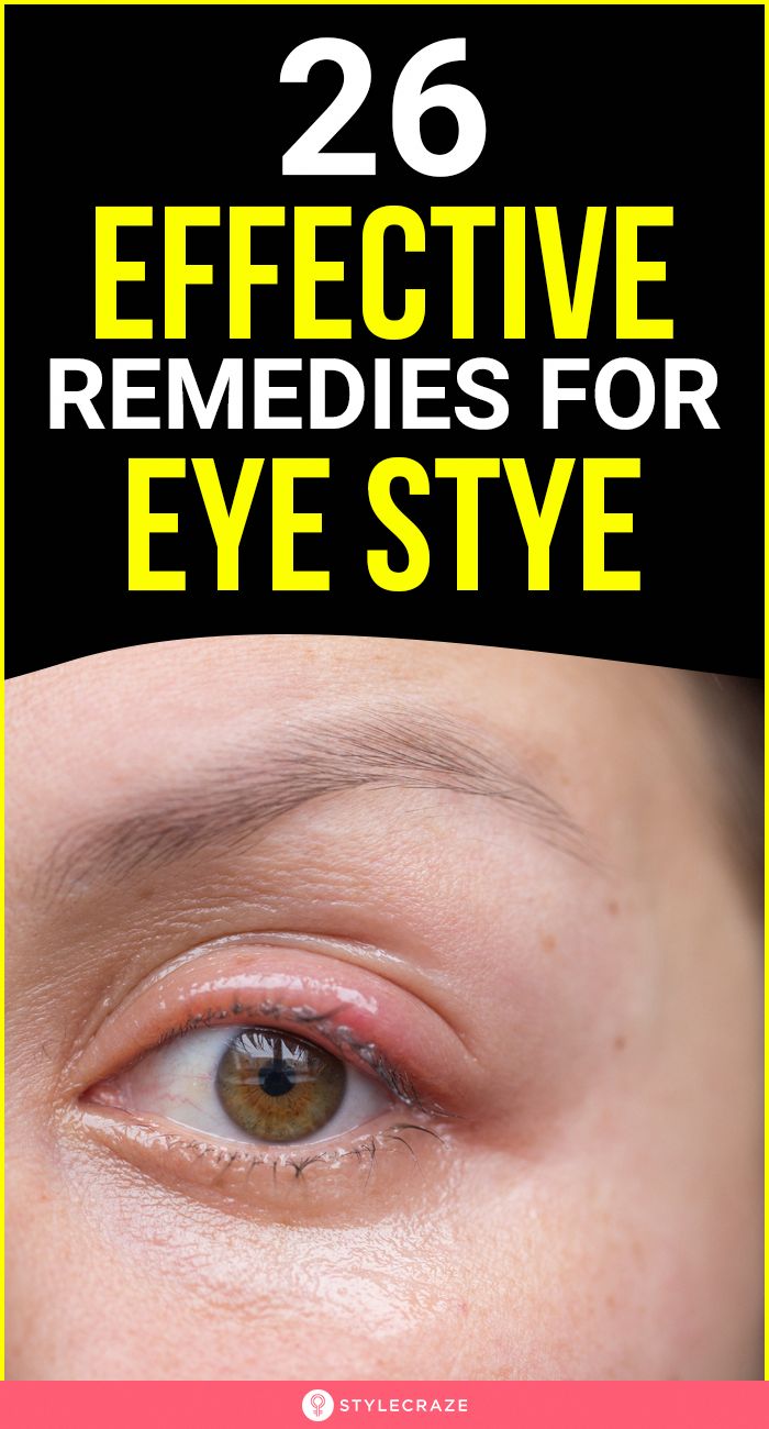 You can easily get rid of a stye with the ingredients you can find in your kitchen. Read on to learn how to get rid of a style without a trip to the doctor. Sty In Eye Remedies, Get Rid Of Stye, Stye Remedy, Eye Stye Remedies, Cold Sores Remedies, Sore Eyes, Natural Sleep Remedies, Natural Cold Remedies, Natural Cough Remedies