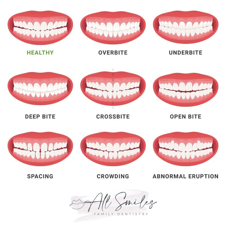 Straight Teeth With Braces, Teeth Types, Straighten Teeth Without Braces, Perfect Smile Teeth, Teeth Correction, Teeth Problems, Dental Animation, Braces Pain, Myofunctional Therapy