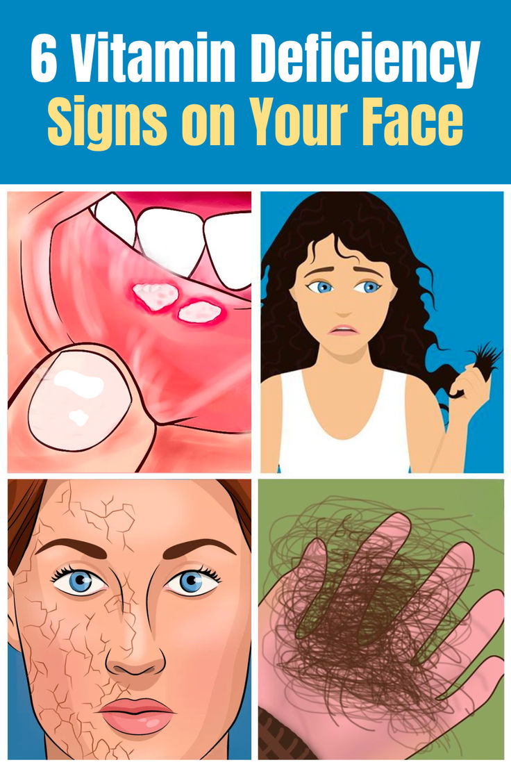 Signs of vitamin deficiency on the face may include a pale complexion, dry or flaky skin, acne or breakouts, angular cheilitis, dark circles, and premature aging, highlighting the importance of proper nutrition for skin health. #nails #nailhealth #vitamindeficiency #brittlenails Vitamin Deficiency Symptoms Chart, Vitamin Deficiency Chart, Vitamin Deficiency Symptoms, Angular Cheilitis, Health Nails, Mineral Deficiency, Pale Complexion, Vitamin Deficiency, Skin Nutrition