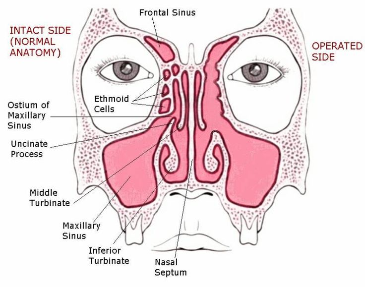 what is sinus surgery side by side Sinus Anatomy, Acne On Nose, Rhinoplasty Recovery, Sinus Health, Maxillary Sinus, Nasal Obstruction, Sinus Allergies, Basic Anatomy And Physiology, Sinus Relief