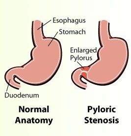 Gi Nursing, Nursing Ob, Pediatrics Nursing, Pyloric Stenosis, Peds Nursing, Physician Assistant School, Peds Nurse, Pediatric Surgery, Nurse Jackie