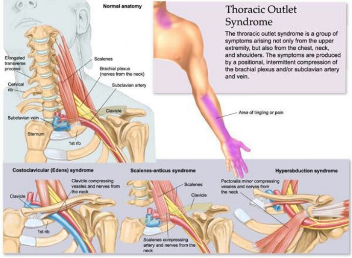 Thoracic outlet syndrome Thoracic Outlet, Massage Marketing, Physical Therapist Assistant, Muscle Anatomy, Hand Therapy, Massage Techniques, Nerve Pain, Massage Therapist, Reflexology