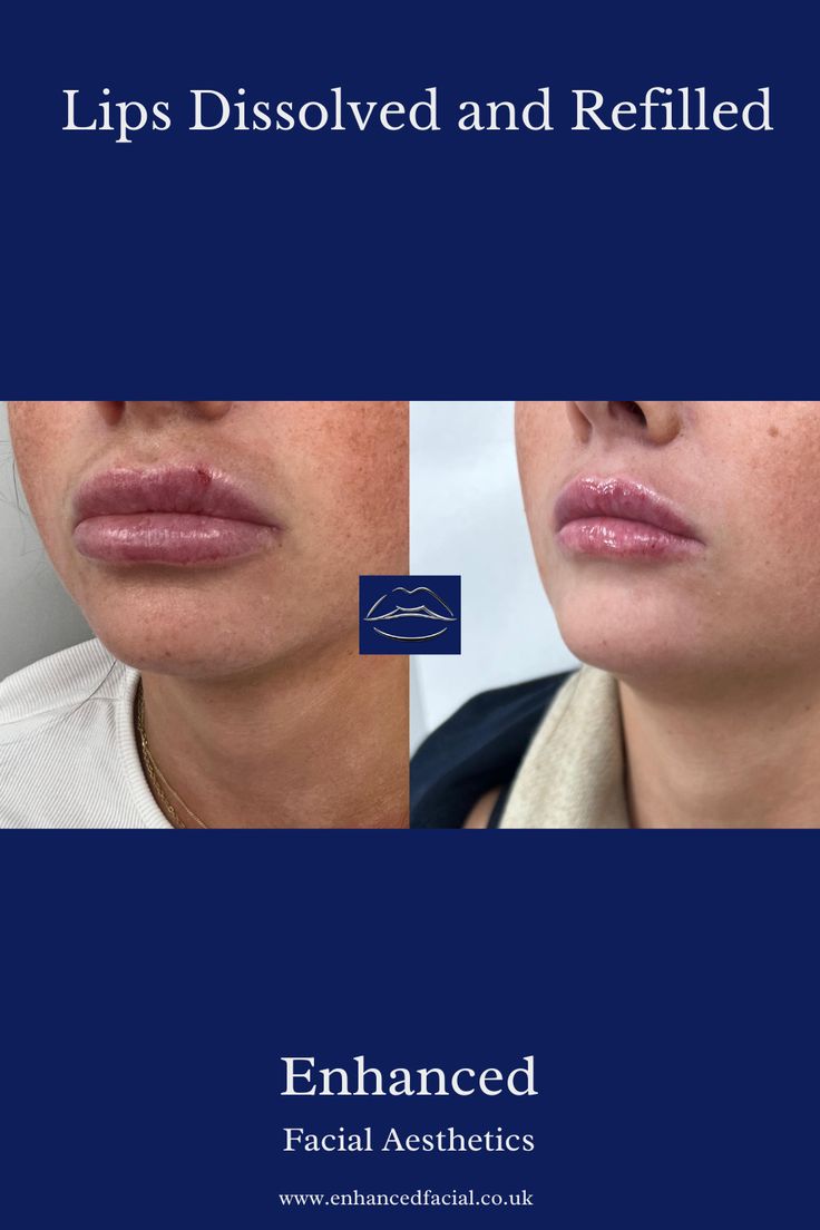 This lovely girl was fed up of the shadow above her lip, so we dissolved it! Two weeks between both pictures. We dissolved, then we refilled. I’m sure we can all agree that the after picture is SO much better. In fact it doesn’t even look like the same girl (which I can assure you it is) 🤩 We are totally over the moon with the results, lips are back to looking natural ✨ 1ml Lip Filler, Facial Aesthetics, Lip Filler, Lip Fillers, Love Natural, Fed Up, Natural Lips, The Shadow, Over The Moon