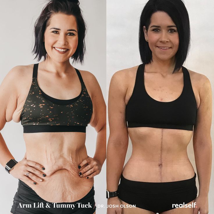 Significant weight loss often results in sagging skin due to lack of elasticity. For this result, a fleur de lis tummy tuck removed excess skin using a vertical incision, while an arm lift removed sagging skin on the arms. Loose Skin Surgery, Arm Lift Surgery, Tummy Tucks Recovery, Skin Removal Surgery, Mommy Makeover Surgery, Skin Tightening Stomach, Loose Belly, Tighten Loose Skin, Arm Lift