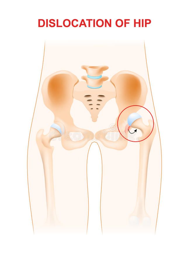 Dislocation of hip stock illustration Hip Dislocation, Pelvic Bone, Human Anatomy, Anatomy, Stock Illustration, Vector Illustration, Texas, Health