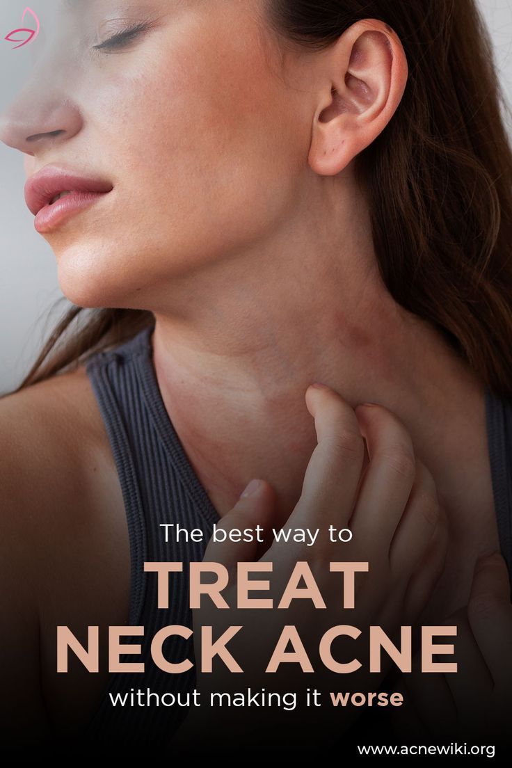 The best way to treat neck acne without making it worse Hair usually frequents certain areas of your body while forsaking other parts, for instance your head, upper lip, chin, chest, parts of your arms and legs and so on. Likewise, acne also tends to appear on certain parts of your body but not others. In this article we will go on a mapping survey of the areas where acne breakouts always take place, why it is so and how to prevent it from appearing. Acne breakouts on the neck This type of a... Jawline Acne, Cheek Acne, Neck Acne, Chin Acne, Bad Acne, Flaking Skin, Pore Strips, Types Of Acne, Acne Breakout