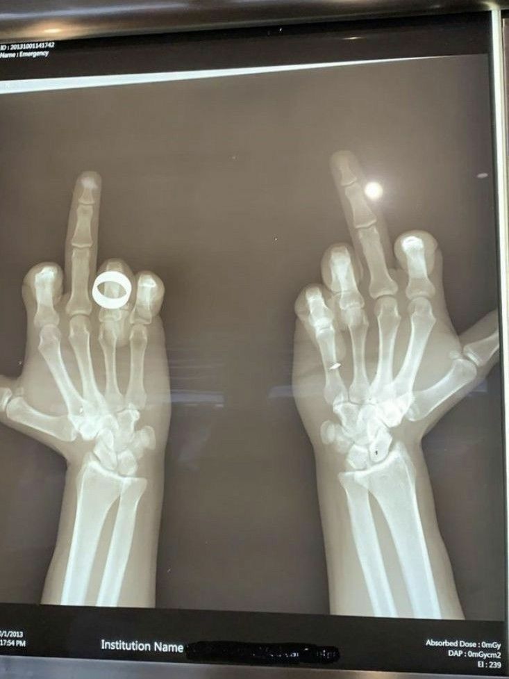 an x - ray image of two hands with the fingers extended