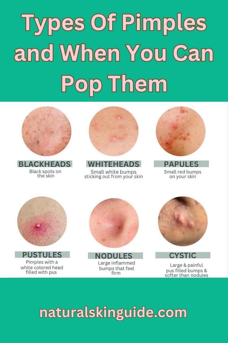 Big Pimple, Back Acne Remedies, Cystic Pimple, Blind Pimple, Forehead Acne, Pimples Under The Skin, Acne Overnight, Pimples Overnight, Pimples Remedies