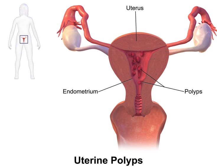 Polyps Uterus, Endometrial Polyps, Uterine Polyps, Oxalate Diet, Fibroid Uterus, Low Oxalate, دورة شهرية, I Know Nothing, Polycystic Ovaries