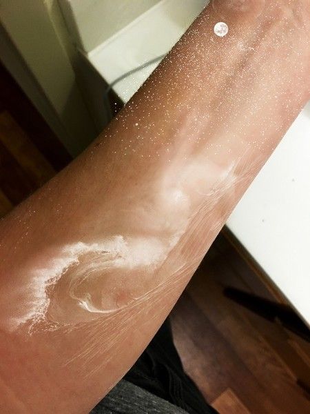 a person with white spots on their arm