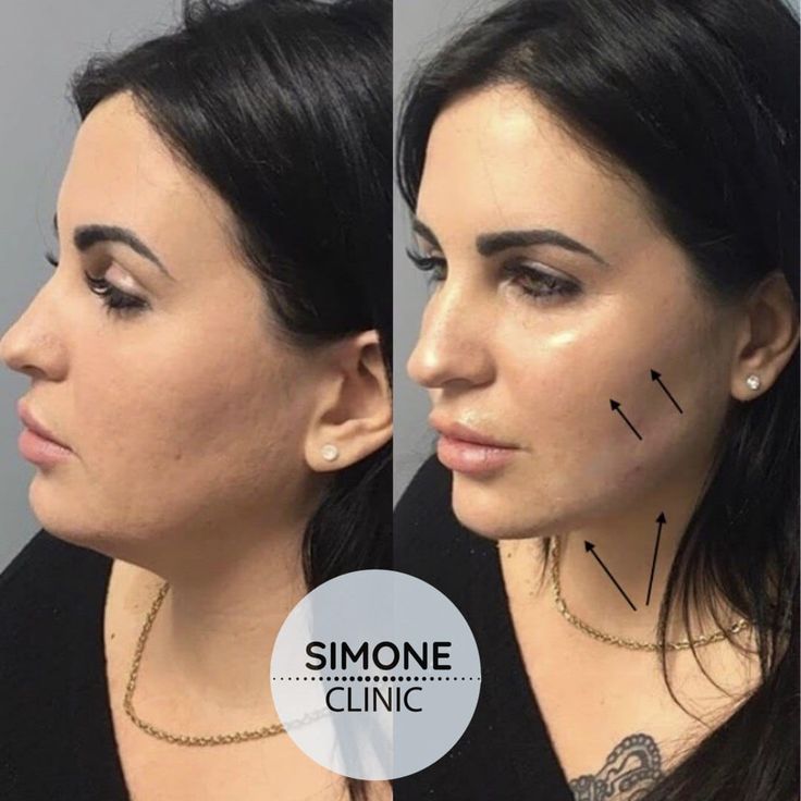 Jaw Filler, Soprano Ice Laser, Anti Wrinkle Injections, Cheek Fillers, Porcelain Skin, Nasolabial Folds, Anti Aging Tips, Dermal Fillers, Lip Fillers