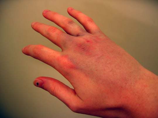 a person's hand with red spots on it