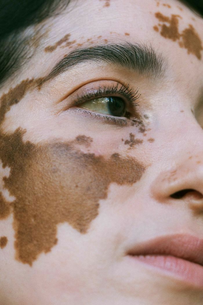 a woman with brown spots on her face