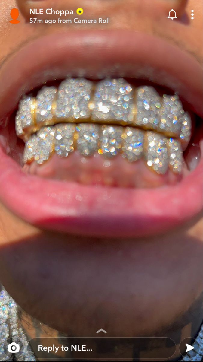 a close up view of a person's mouth with braces and diamonds on it