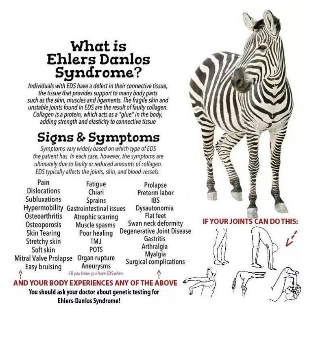 Vascular Ehlers Danlos Syndrome, Ehlers Danlos Syndrome Types, Ehlers Danlos Syndrome Symptoms, Elhers Danlos Syndrome, Ehlers Danlos Syndrome Hypermobility, Ehlers Danlos Syndrome Awareness, Party Tricks, Rare Disorders, Chiari Malformation