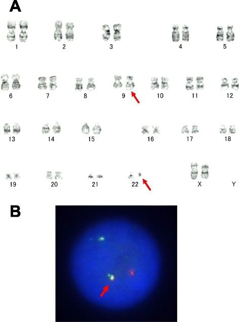 What is Chronic Myelogenous Leukemia? - Pathosomes Essential Thrombocythemia, Cell Line, White Blood, White Blood Cells, Red Blood, Red Blood Cells, Blood Cells, Medical Information, Stem Cells