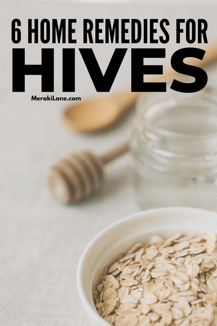 How to Get Rid of Hives | Whether your hives (or urticaria) are chronic or acute, caused by a histamine intolerance, an allergic reaction, or stress, finding relief for this itchy and irritating rash is important. In this post, we share everything you need to know - the signs and symptoms of hives, common causes, and natural remedies for fast relief. From at-home treatments like oatmeal and baking soda baths, witch hazel, cold compresses, and more, these home remedies work! Face Rash Remedies How To Get Rid, Oatmeal Bath For Hives, Natural Hives Remedy, Remedies For Hives, Get Rid Of Hives Fast, Natural Itch Relief Skin, Itchy Rash Remedies, Allergic Reaction Rash Remedies, Allergic Reaction Remedies