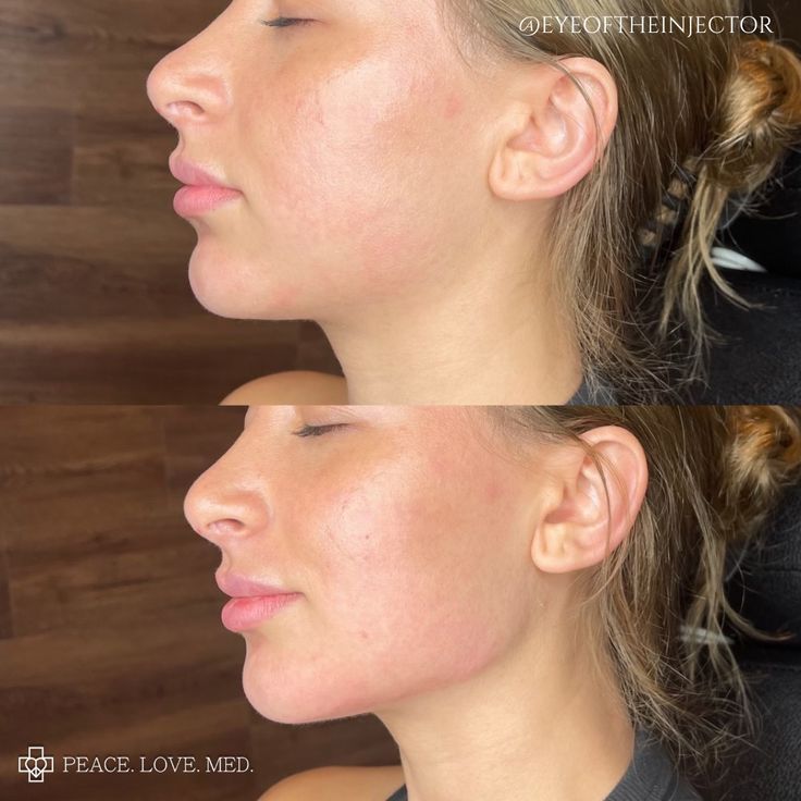 Cheek And Jaw Fillers, Jaw Line Botox Before And After, Jaw And Chin Filler Before And After, Before And After Jaw Filler, Botox For Slimmer Face, Jaw Contouring Filler, Jawline Contouring Filler, Facial Balancing Filler Before And After, Jaw And Chin Filler