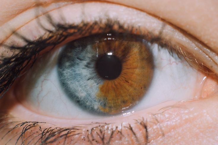 In people affected by complete heterochromia, one iris is a different color from the other. Segmental heterochromia occurs when areas of the same iris are different in color. 11.12.2017 Cat Eye Syndrome, Sectoral Heterochromia, Bowie Eyes, Hair Whorl, Heterochromia Eyes, Beautiful Eyes Color, Different Colored Eyes, The Dark Artifices, Aesthetic Eyes