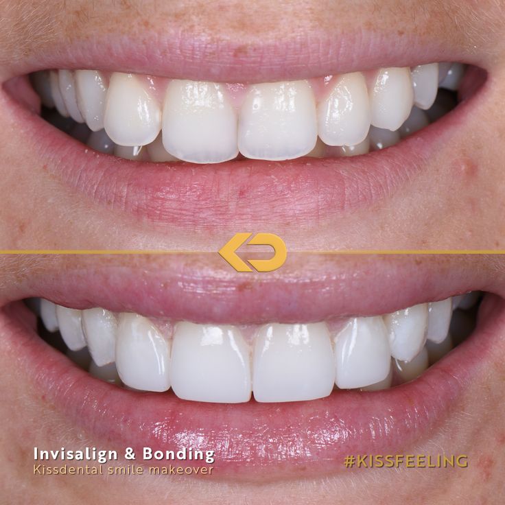 Edge Bonding Teeth Before And After, Composite Edge Bonding Teeth, Edge Bonding Teeth, Teeth Makeover, Perfect Smile Teeth, Teeth Correction, Naturally Whiten Teeth, Teeth Bonding, Smile Book