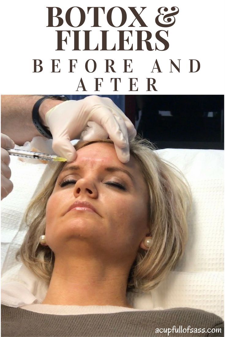 Botox Under Eyes, Best Wrinkle Filler, Botox Forehead, Botox Injection Sites, Derma Fillers, Botox And Fillers, Botox Brow Lift, Under Eye Fillers, Botox Before And After