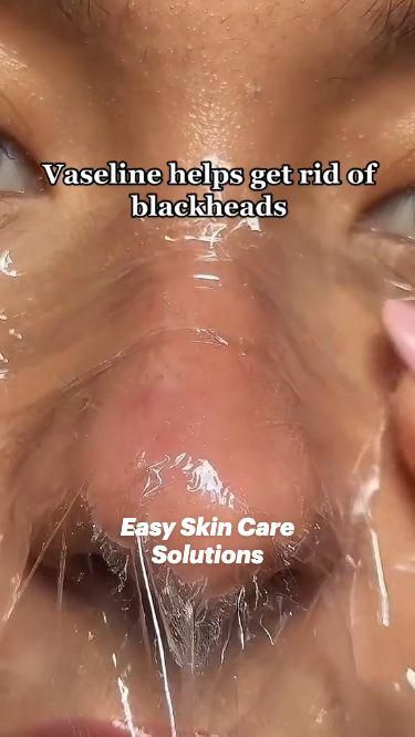 #RemediesToGetRidOfACold Back Acne Remedies, Glowup Tips, Easy Skin Care, Skin Care Hacks, Blind Pimple, Acne Overnight, Skincare Hacks, Cold Sores, Cold Sores Remedies