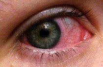 You won't believe how simple it is to clear this up WITHOUT a trip to the waiting room and a bill! Pinkeye Remedy! gonna repin this now, just in case it's needed later Pinkeye Remedies, The Waiting Room, Pink Eye, E Mc2, Homemade Remedies, Animal Pics, Diy Health, Pink Eyes, Back To Nature