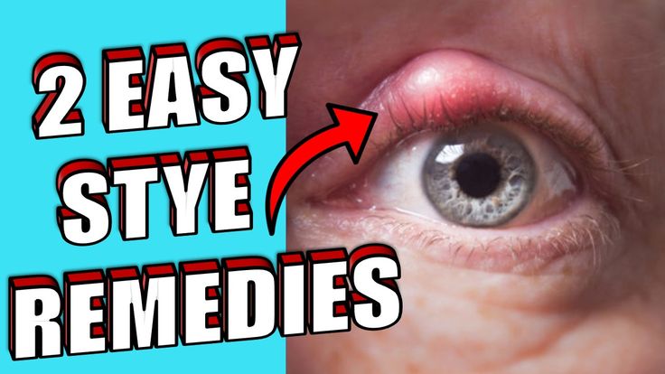 EYE STYES They're caused by the development of infection in a cyst that forms at the base of an eyelash. The initial lump can become inflamed and eventually discharge pus. In this video we are going to cover two effective home remedies that are easy to do. The fist one is salt water Salt has healing properties that will help your stye to go away faster. It will also reduce any pus that has gathered in the stye Stye Remedies Fast How To Get Rid, Stye Remedies Fast, Stye Remedies, Stye Remedy, Eye Stye Remedies, Living A Healthy Life, Salt And Water, Healing Properties, Natural Health