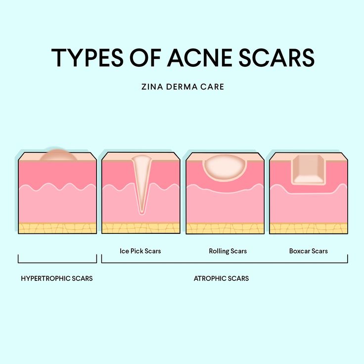 🌟 Demystifying Acne Scars: Understanding the Types 🌟 ✨ HYPERTROPHIC SCARS: These little rebels defy the norms! They’re raised and can sometimes be itchy or uncomfortable. But fear not, they’re just a temporary blip on your skin’s journey to radiance! 💪🏽 ✨ ATROPHIC SCARS: Let’s meet the divas of the acne scar world! Ice Pick Scars, Rolling Scars, and Boxcar Scars. Each with their own unique charm, they leave behind small pits, shallow depressions, or wavy textures. But remember, even divas c... Ice Pick Scars, Different Types Of Acne, Hypertrophic Scars, Ice Pick, Face Care Routine, Acne Scar, Types Of Acne, Forehead Wrinkles, Acne Scar Removal