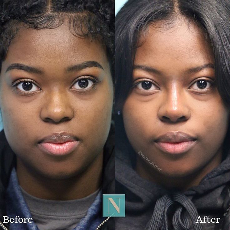 Rhinoplasty & Cosmetic Surgery on Instagram: “Nonsurgical Rhinoplasty by The Noseman on a young woman who came wanting a more defined and contoured bridge. The tip has also improved and…” Rhinoplasty Before And After Black Women, Small Nose Tip, Ethnic Rhinoplasty African Americans, Black Rhinoplasty, Lower Blephoraplasty Before And After, Rhinoplasty Before After, Ethnic Nose Job, Feminine Goals, Kpop Plastic Surgery