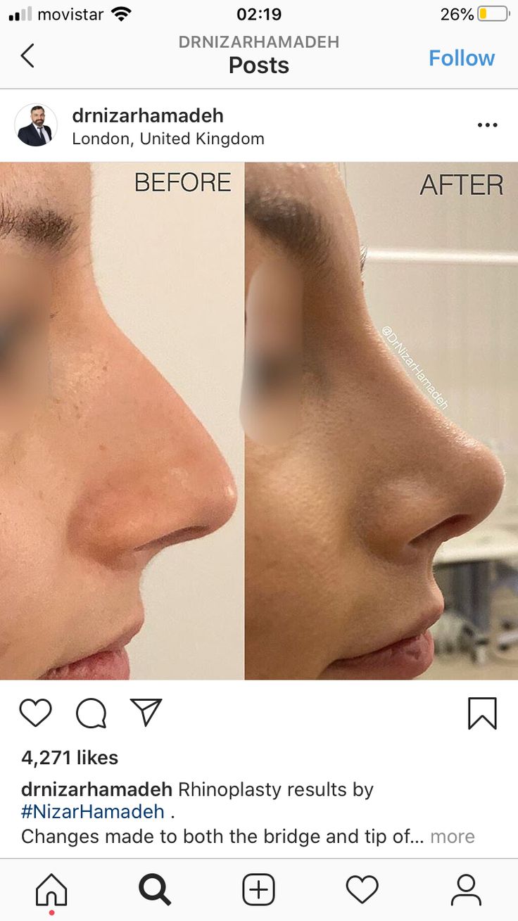 Rhinoplasty Front View, Nose Job Inspiration, Nose Plastic Surgery, Nose Surgery Rhinoplasty, Nose Fillers, Nose Types, Nose Jobs, Rhinoplasty Nose Jobs, Face Fillers