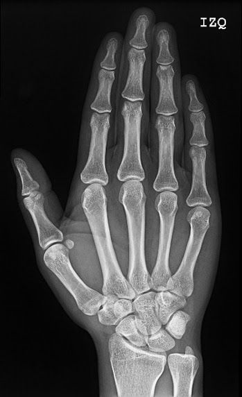 an x - ray image of the hand and wrist bones, showing different areas of the thumb area